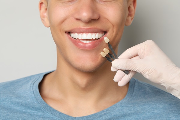 Top Reasons To Consider Dental Veneers For Your Teeth