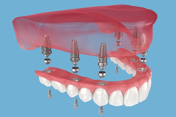 Implant Supported Dentures Can Solve The Problem Of Missing Teeth